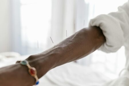 Close-up of acupuncture needles on treatment table with soft lighting
